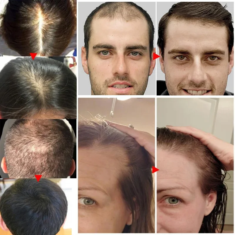 Gember Haargroei Etherische Ol - Hair Care Essential Oil Atomizing recensie en prijs